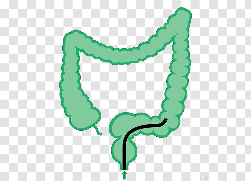 Colonoscopy Large Intestine Sigmoid Colon Descending - Rectum Transparent PNG