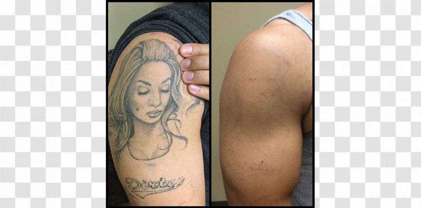 Absolute Laser Tattoo Removal Artist Abziehtattoo - Heart - Tree Transparent PNG