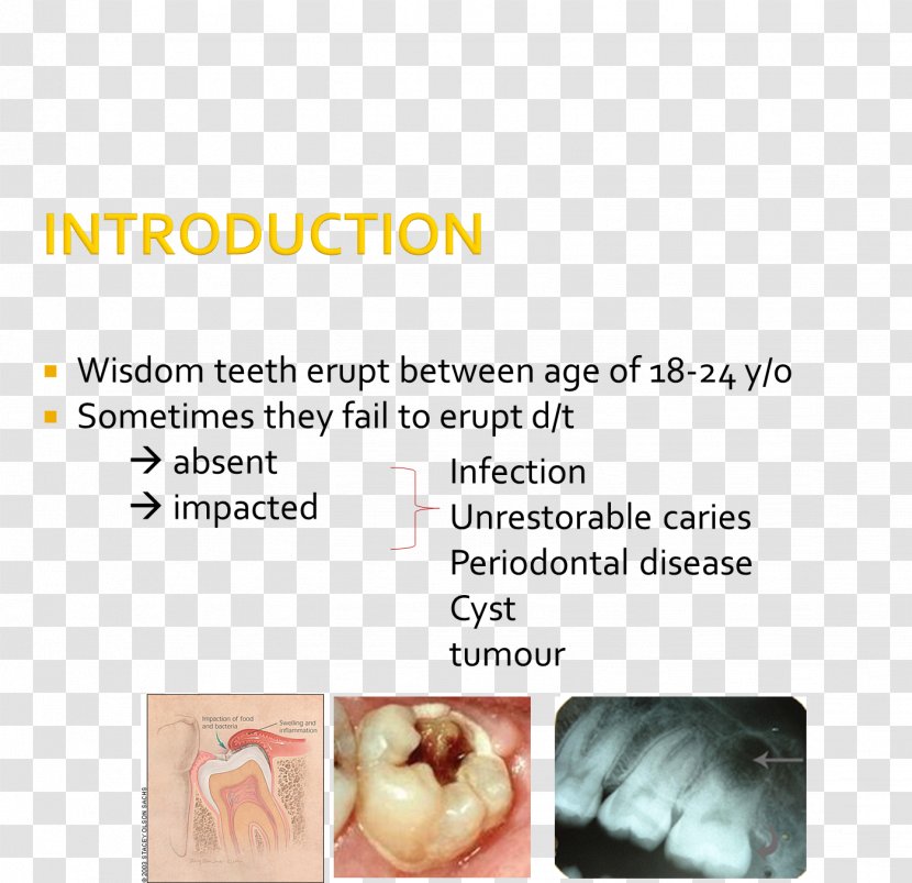 Wisdom Tooth Impacted Teeth Impaction Jaw Molar - Maxilla Transparent PNG