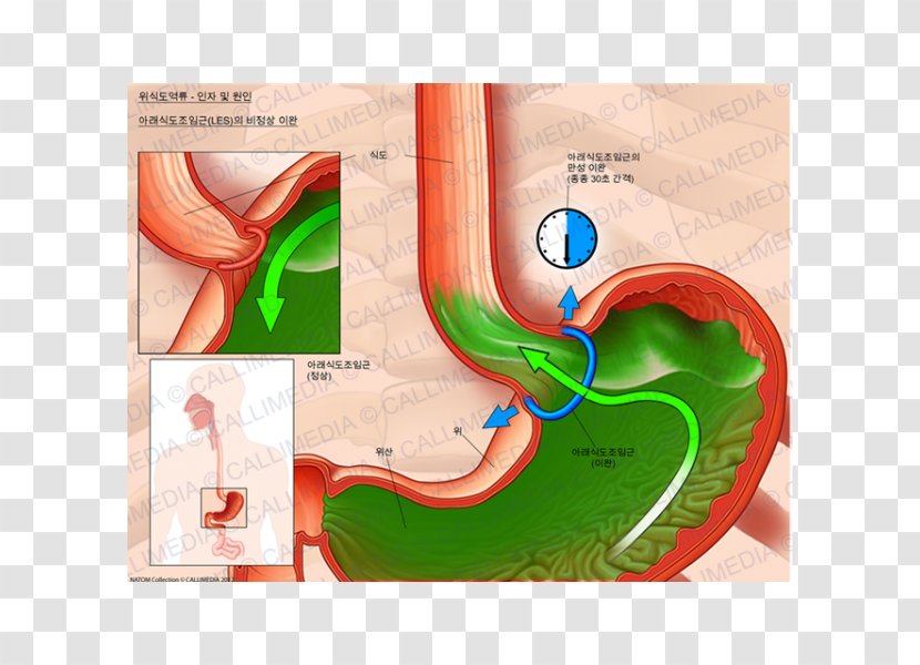 Esophagus Sphincter Cardia Sfintere Esofageo Inferiore Gastroesophageal Reflux Disease - Heart Transparent PNG