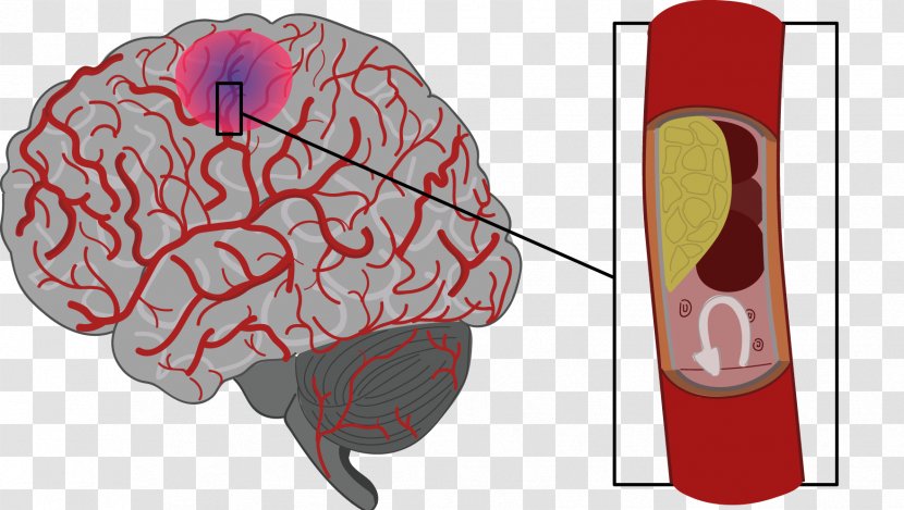 Stroke Brain Haemorrhage Agy Risk Factor - Heart - Gingival Bleeding Transparent PNG