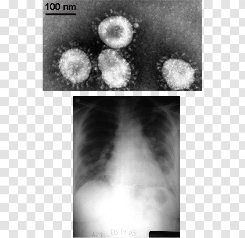 Middle East Respiratory Syndrome Coronavirus Severe Acute Coronaviridae - Pneumonia Pathophysiology Transparent PNG