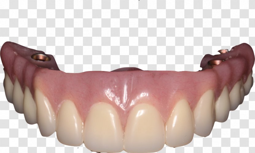 Tooth Dentures Dental Implant Removable Partial Denture - Jaw - Bridge Transparent PNG