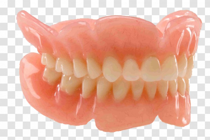 Dentures Dentistry Removable Partial Denture Dental Restoration - Fixed Prosthodontics - Teeth Model Transparent PNG