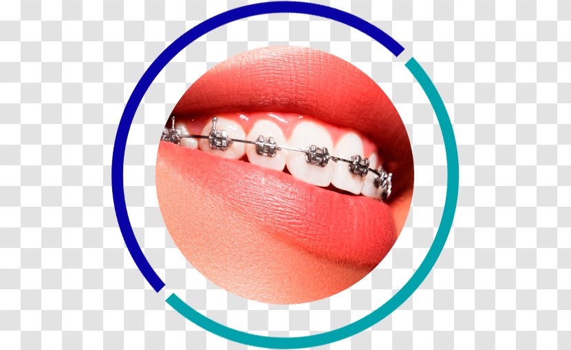 Orthodontics Dentistry Dental Braces Tooth - Clinic - Decay Transparent PNG