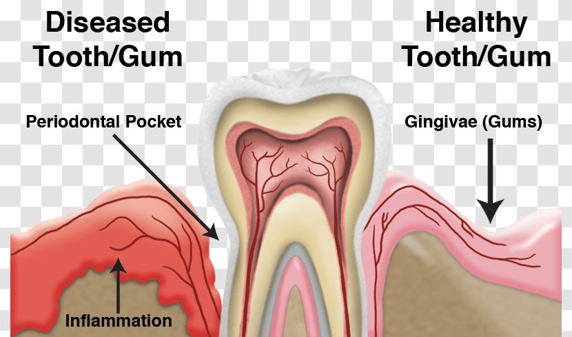 Tooth Periodontal Disease Dentistry Gums - Flower - Health Transparent PNG