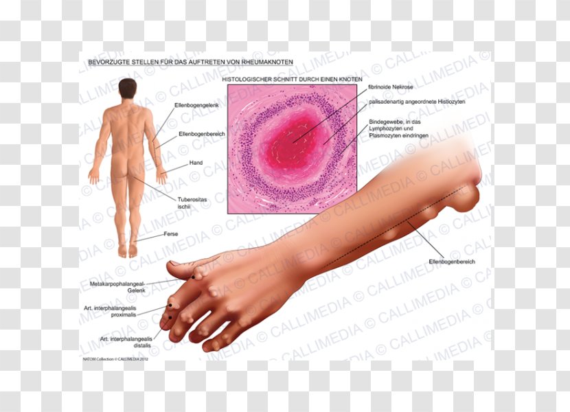 Rheumatoid Nodule Arthritis Rheumatism Disease - Skin - 3d Men Transparent PNG