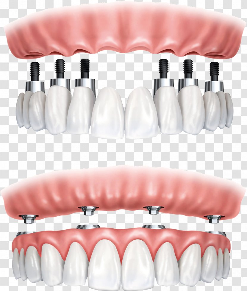All-on-4 Dental Implant Dentistry Dentures - Silhouette - Bridge Transparent PNG