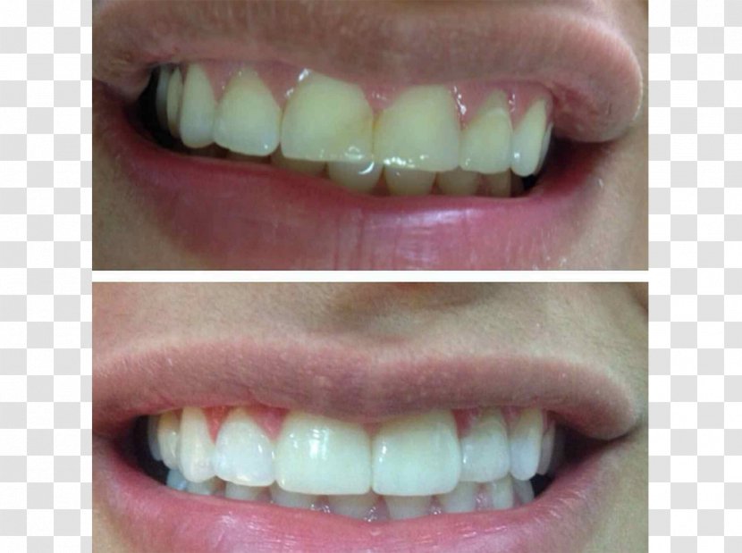 Tooth Veneer Dental Implant Dentist Crown - Sinus Lift Transparent PNG
