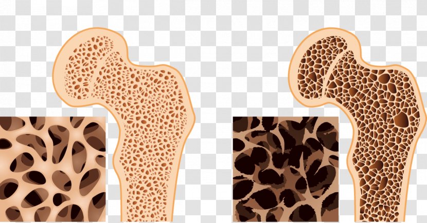 Bone Density Osteoporosis Health Osteopenia - Osteogenesis Imperfecta Transparent PNG