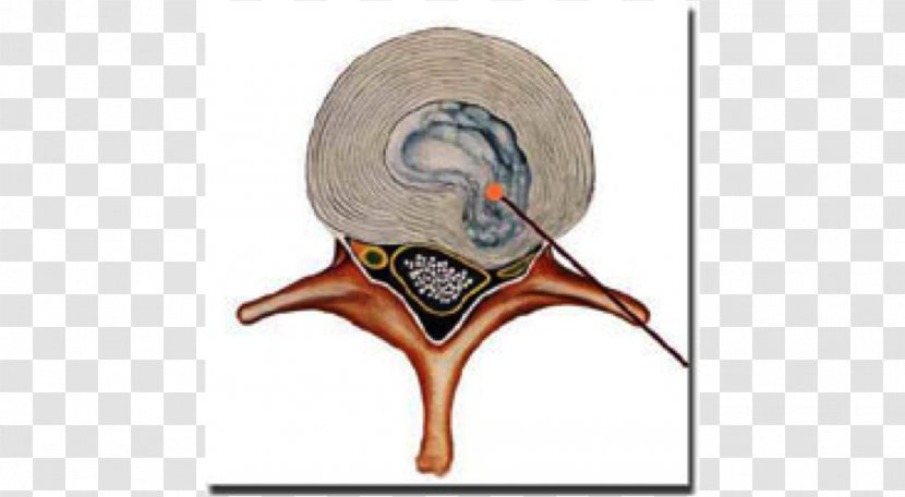Spinal Disc Herniation Therapy Cord Intervertebral 急性腰痛症 - Flower - Medical Procedure Transparent PNG