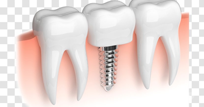 Dental Implant Dentistry Tooth Restoration - Tree - Crown Transparent PNG