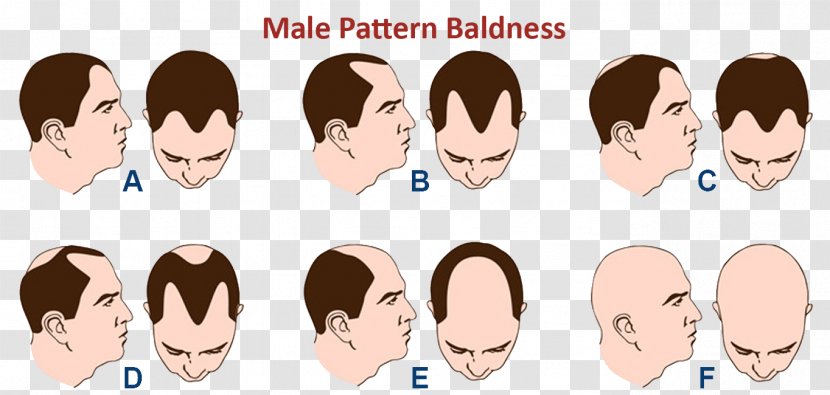 Hair Coloring Pattern Loss Pubic - Silhouette Transparent PNG