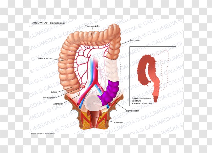 Colorectal Cancer Surgery Colon - Tree - Sigmoid Transparent PNG