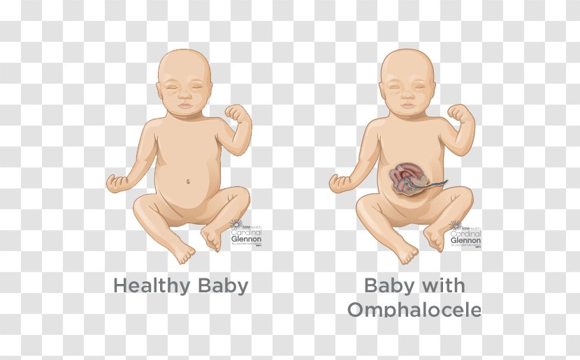 Pulmonary Hypoplasia Congenital Airway Malformation Birth Defect Lung Artery - Heart - Diagnosis And Treatment Transparent PNG