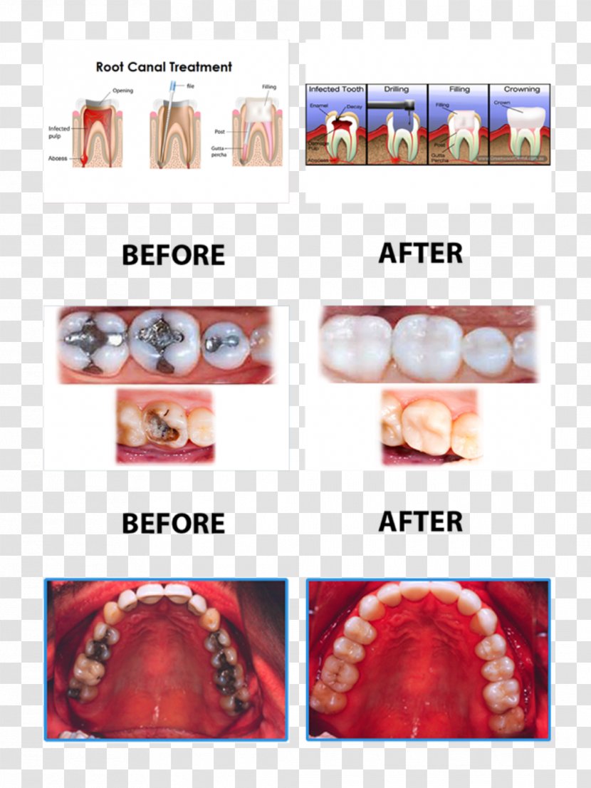 Surgery Dentistry Root Canal Dental Extraction - Tooth Transparent PNG
