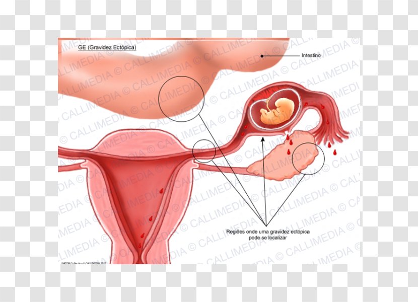 Ectopic Pregnancy Uterus Gynaecology Symptom - Silhouette Transparent PNG