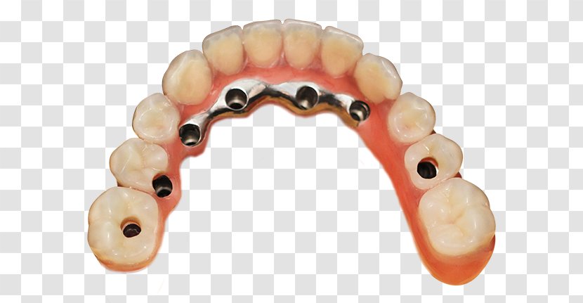 Tooth Dentures Crown Bridge Implantology - Process Transparent PNG