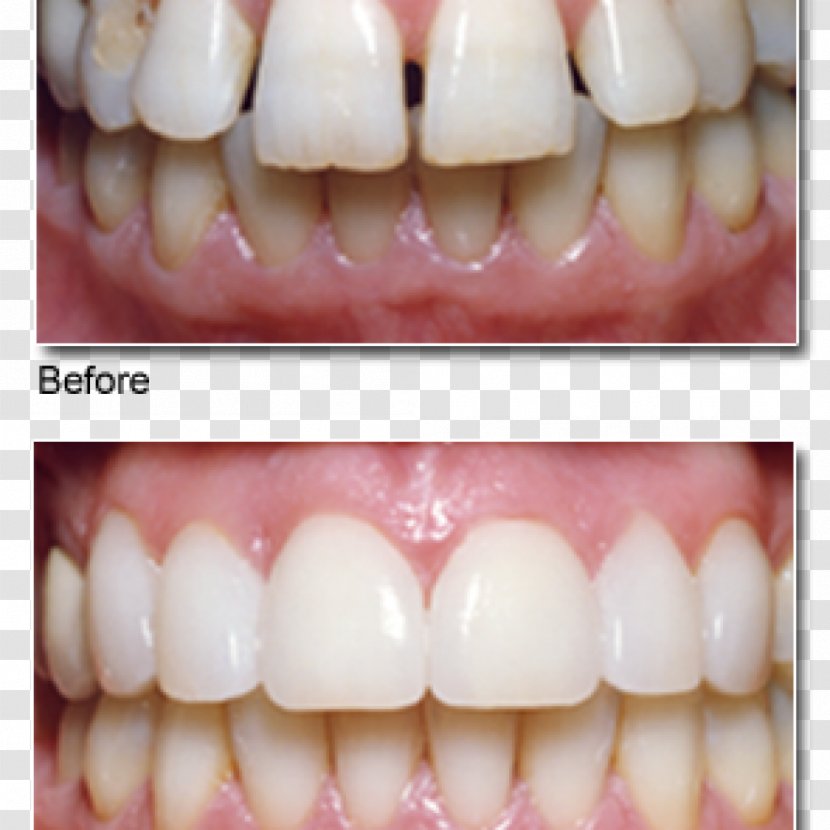Veneer Cosmetic Dentistry Chris Johns, DDS - Patient Transparent PNG