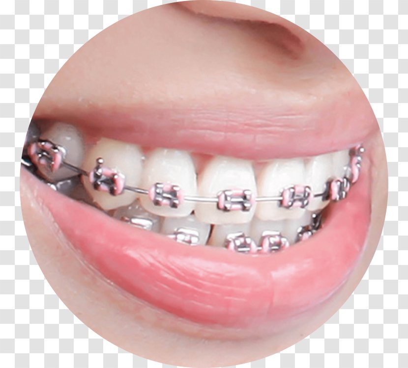 Dental Braces Dentistry Orthodontics Human Tooth - Mouth - Surgery Transparent PNG