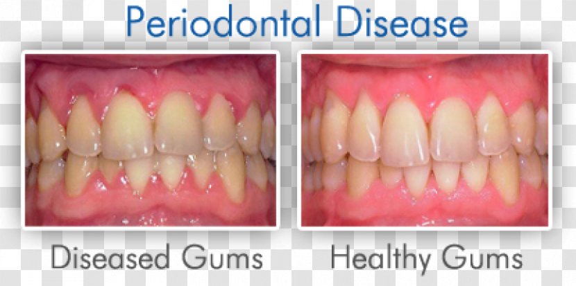 Swollen Gums Gingivitis Periodontal Disease Dentistry - Mouth Transparent PNG