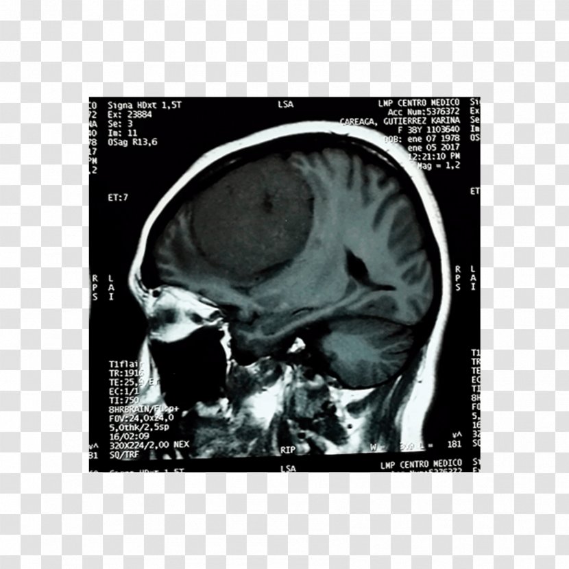 Computed Tomography Brain Tumor Agy Cancer Skull - Silhouette Transparent PNG