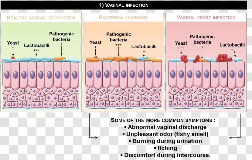 Vaginitis Disease Naver Blog Candidiasis Therapy - Common Cold - Infection Transparent PNG