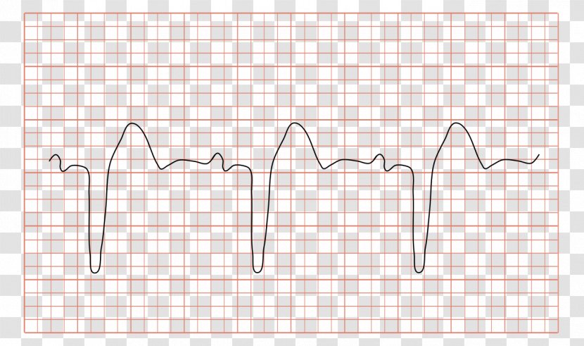 Left Bundle Branch Block Right Branches Electrocardiography - Cartoon - Ecg Transparent PNG