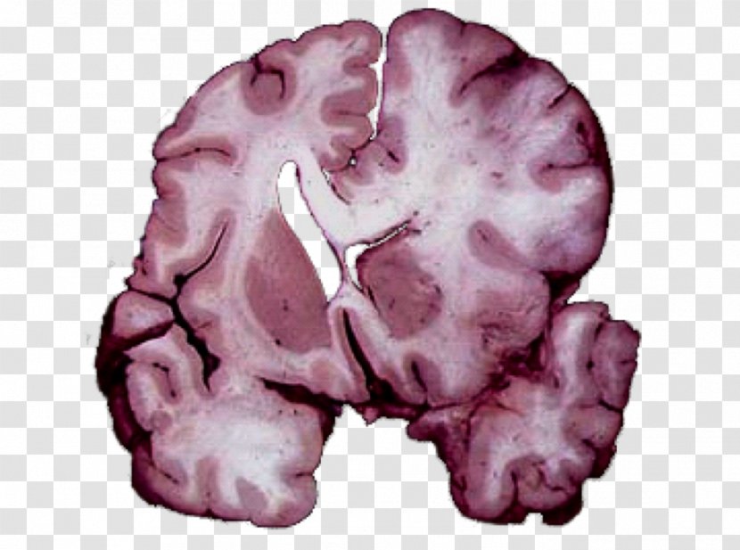 Brain Herniation Intracranial Pressure Traumatic Injury Cerebellar Tonsil - Frame Transparent PNG
