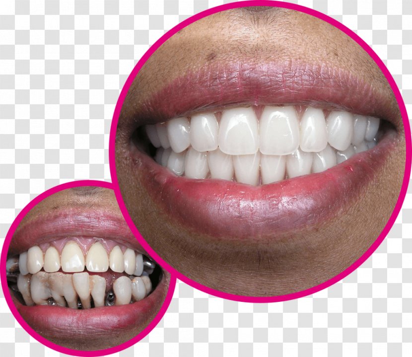 Tooth Gebiss Dentist Dentures Implant - Smile - Kiesq Praktijk Voor Tandheelkunde Transparent PNG