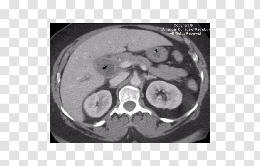 Computed Tomography Bone Organism - Monochrome - Fistula Transparent PNG