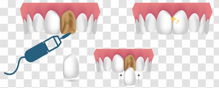 Cosmetic Dentistry Veneer Dental Composite Human Tooth - Hospital Transparent PNG