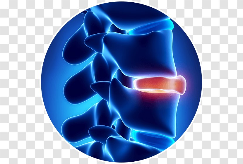 Spinal Disc Herniation Vertebral Column Intervertebral Tratamento Back Pain - Lumbar Disease - Rupture Transparent PNG