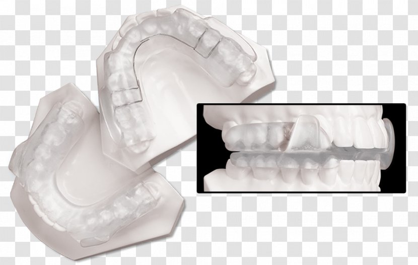 Splint Temporomandibular Joint Dysfunction Dentistry Jaw Orthopedic Surgery - Incisor - Mandible Transparent PNG