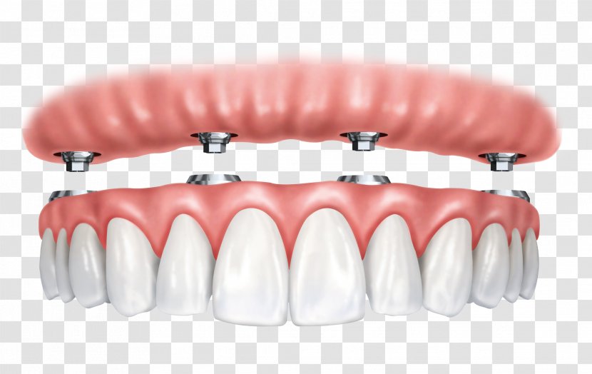 Dental Implant All-on-4 Dentistry Dentures - Implants Transparent PNG