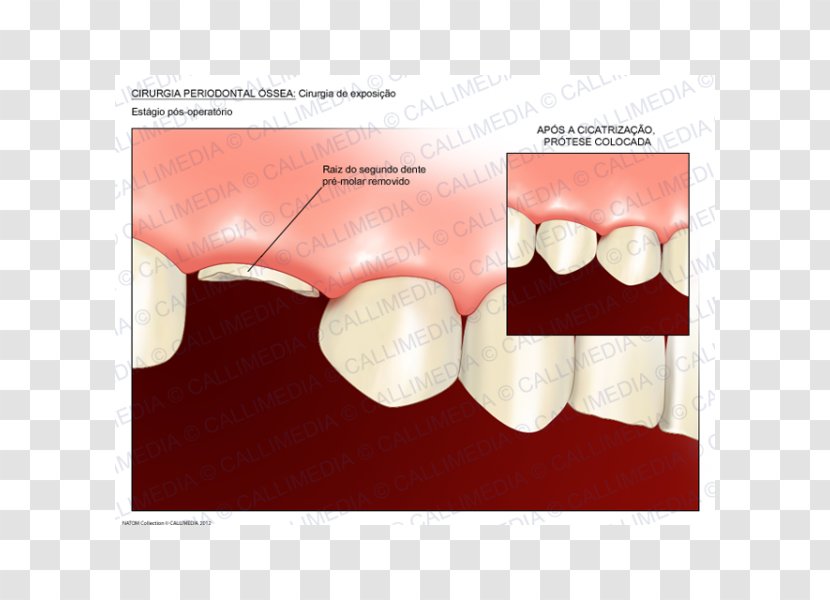 Tooth Crown Lengthening Dentistry Surgery Transparent PNG