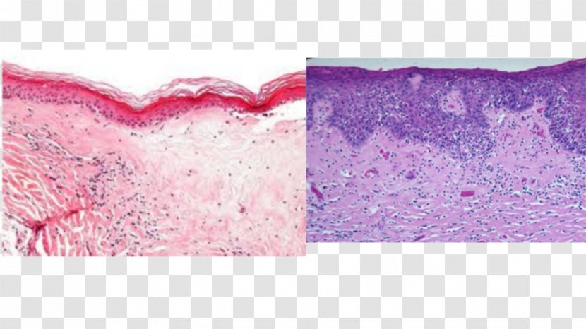 Pink M Lichen Sclerosus Rectangle RTV - Magenta Transparent PNG