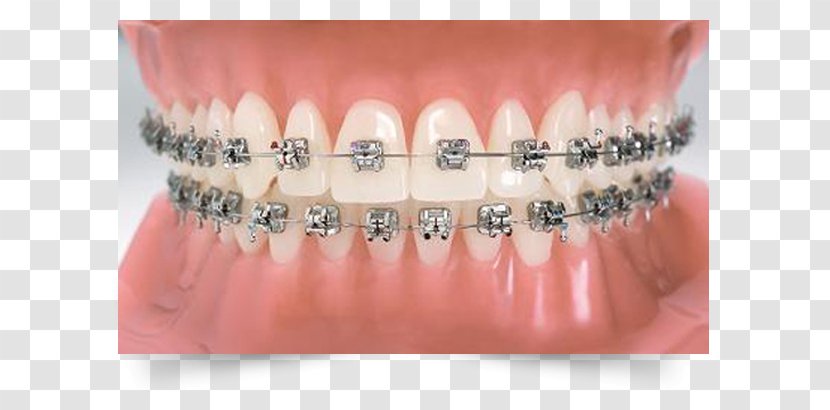 Orthodontics Dental Braces Dentistry Tooth Transparent PNG