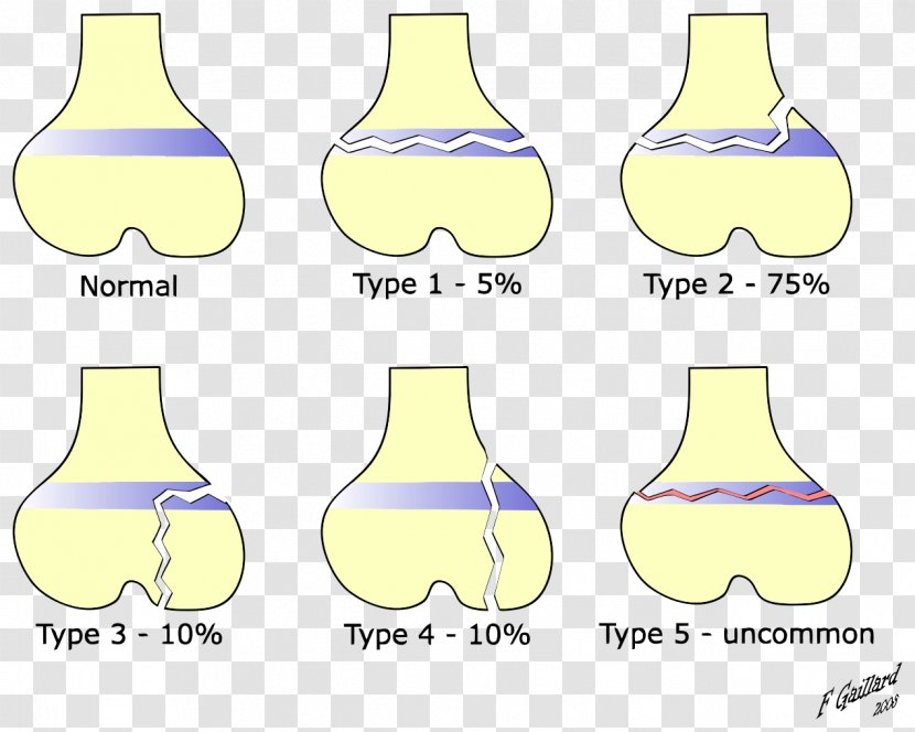 Salter–Harris Fracture Bone Epiphyseal Plate Ankle Metaphysis Transparent PNG