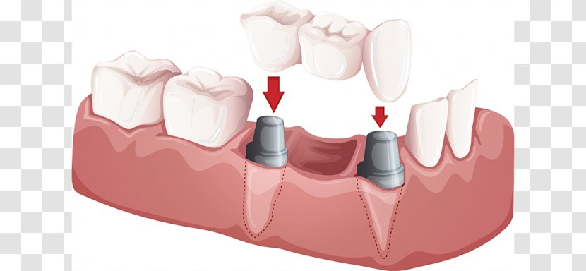 Bridge Dentistry Crown Dental Implant - Heart Transparent PNG