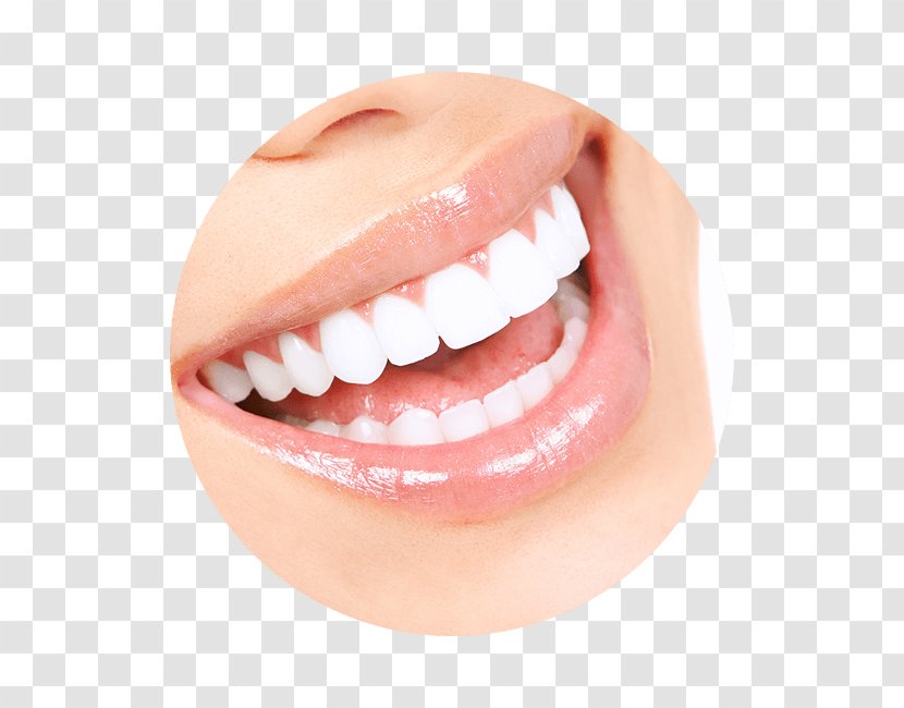 Tooth Whitening Human Dentistry Veneer - Cosmetic Transparent PNG