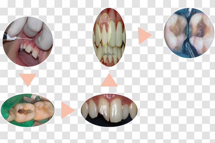 Endodontic Therapy Root Canal Dentistry Ya Lo Sabemos Pulp - Tooth - Endodoncia Transparent PNG