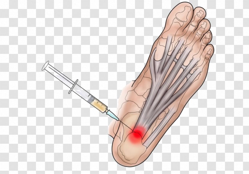 Thumb Plantar Fasciitis Platelet-rich Plasma Therapy Ankle - Heart - Cartoon Transparent PNG