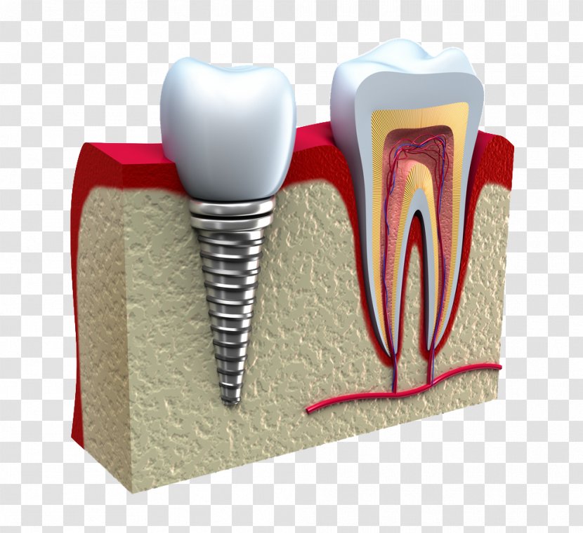 Dental Implant Dentistry Restoration - Cartoon - Teeth Transparent PNG