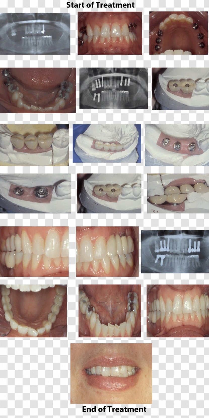 Kapshtica Renis DDS Dental Implant Tooth Dentistry - Dds - Bridge Transparent PNG
