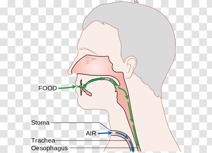 Laryngectomy Voice Prosthesis Larynx Nose - Tree Transparent PNG