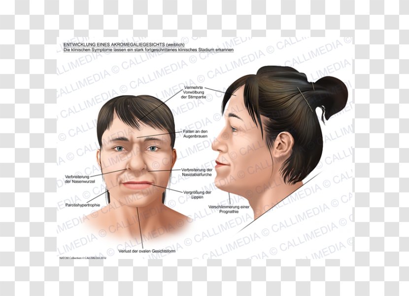 Acromegaly Face Symptom Gigantism Fedeltà è Cambiamento. La Svolta Di Francesco Raccontata Da Vicino - Medicine Transparent PNG