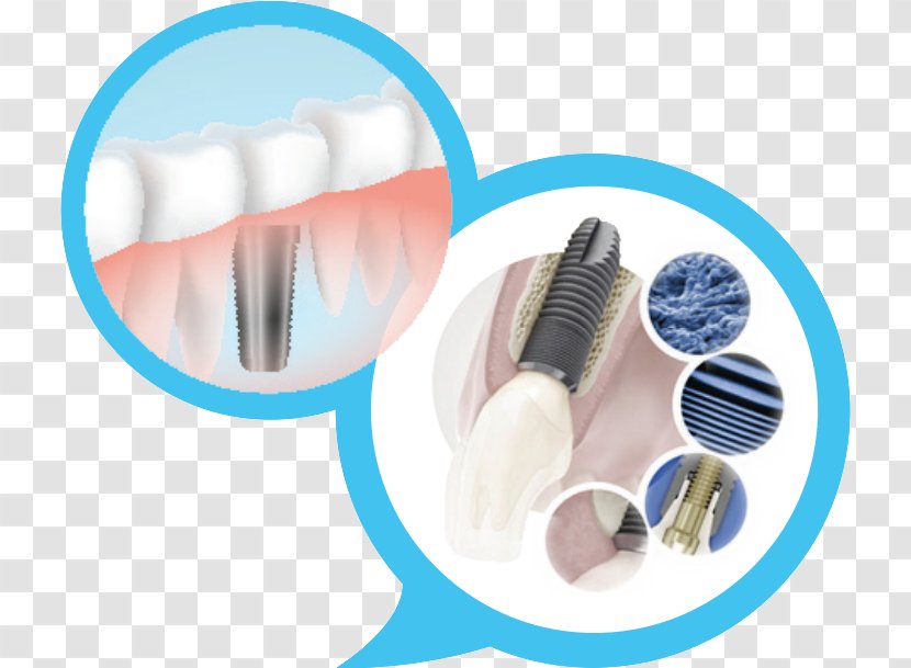 Dental Implant Dentistry OSSTEM IMPLANT - Implants Transparent PNG