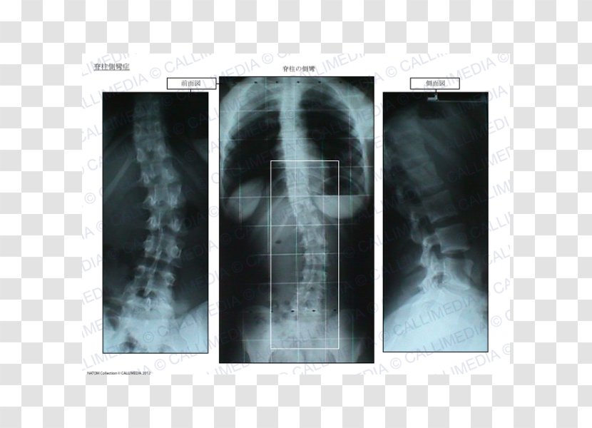 X-ray Radiology Medical Imaging Radiography Poster - Medicine - Scoliosis Transparent PNG