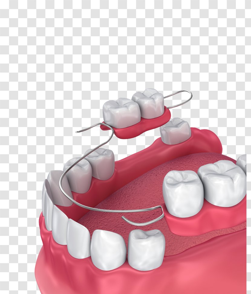 Removable Partial Denture Dentures Dentistry Bridge Tooth Transparent PNG